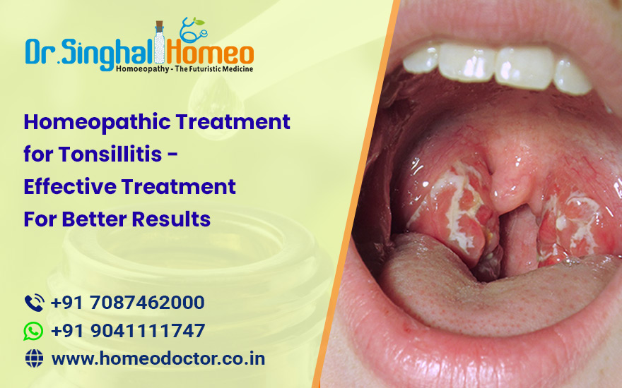 Get Effective Tonsillitis Treatment with Homeopathic Medicines