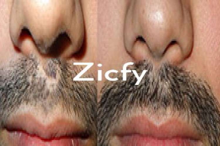 Hair Transplant in India Avail Discount Transplanthairindiacom