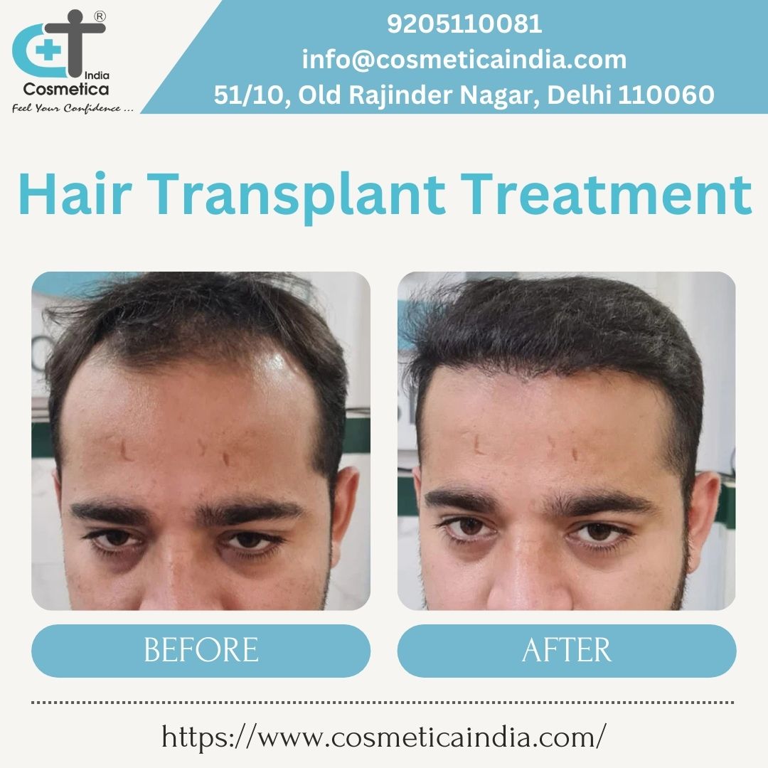 Hair transplant treatment