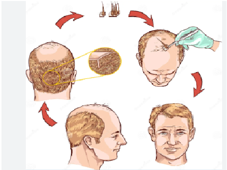hair transplantation in  prayagraj   uttar pradesh