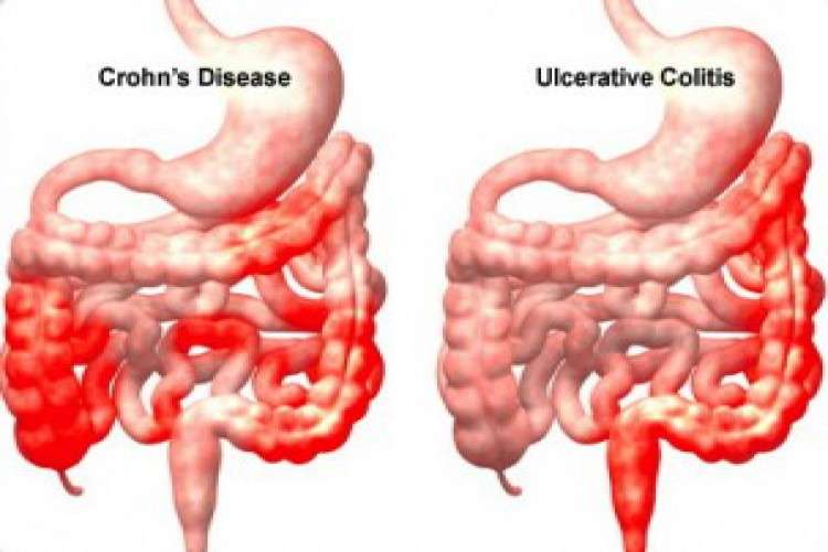 Low Cost Treatment for Ulcerative Colitis without any Colon Surgery
