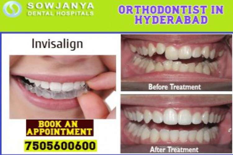 Orthodontist in Hyderabad  Best Invisalign treatment in Himayat Nagar