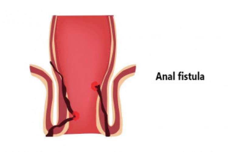 Pilonidal disease Treatment in Gurgaon