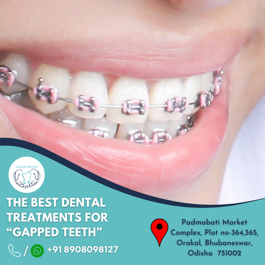 Root canal treatment Sundarpada Bhubaneswar