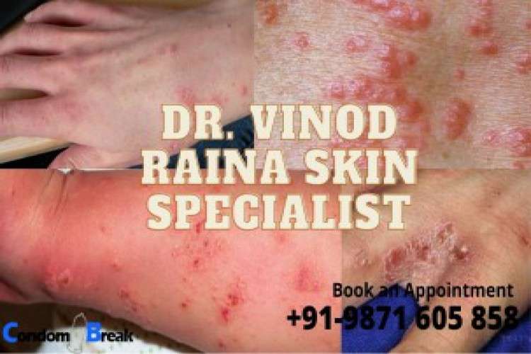 Treat Scabies Infection in Delhi by Dr Raina