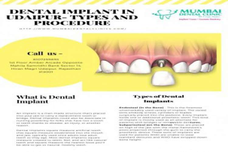 Best dental implant dentist in udaipur