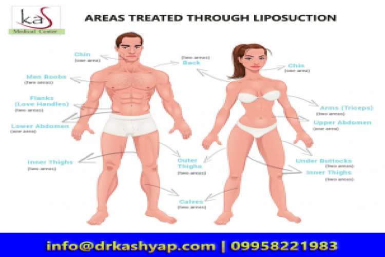 Best liposuction surgery in south delhi