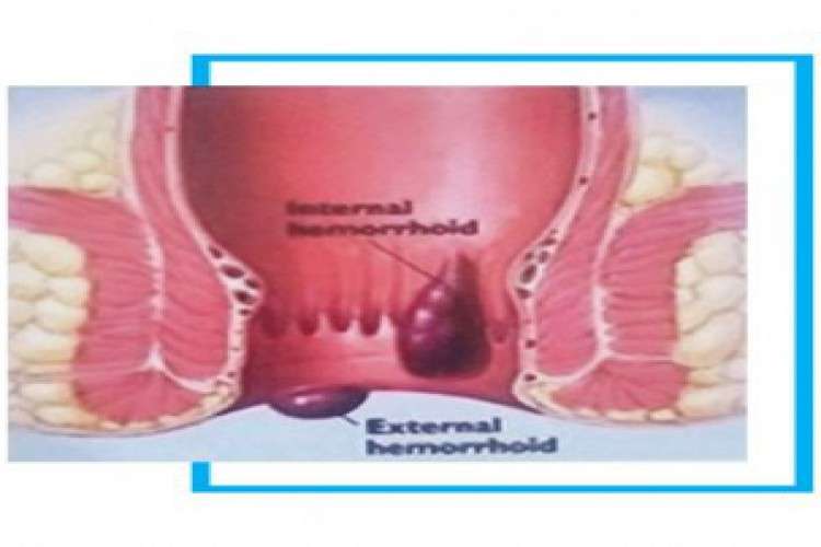 Best treatment for piles haemorrhoidectomy in new delhi