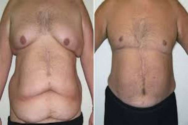 Body lift surgery in lucknow