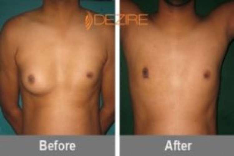 Breast reduction surgery in gurgaon delhi dezire clinic