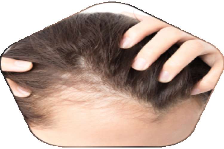 Hair loss treatment in hyderabad