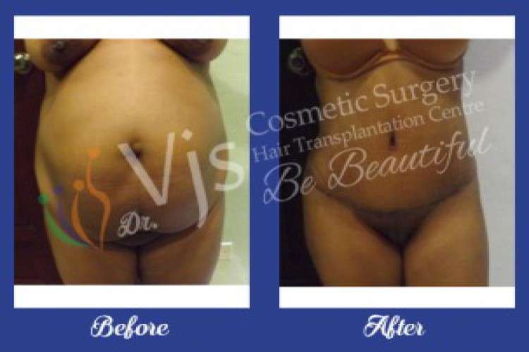 Liposuction surgery in visakhapatnam