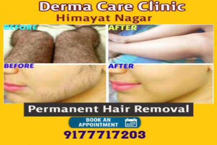 Permanent hair removal in hyderabad