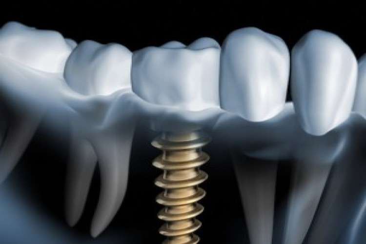 Teeth replacement at lowest dental implant cost