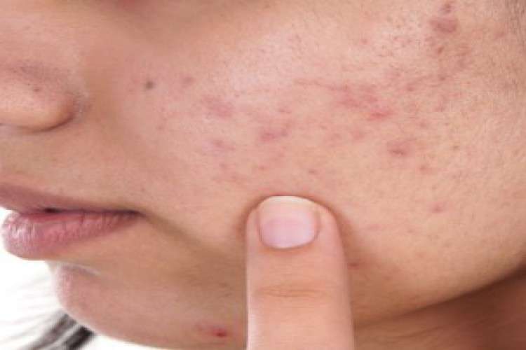 Top five clinics that provide laser treatment for acne scars